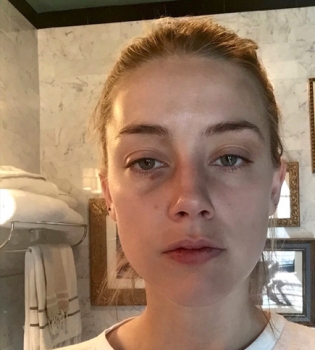 Эмбер Херд обнародовала снимки, сделанные после того, как ее избил Джонни Депп