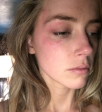 Эксперт подтвердил подлинность фото с побоями, которые Депп нанес Эмбер Херд