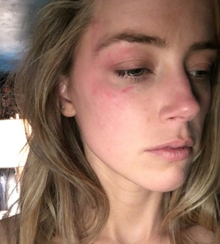 Эксперт подтвердил подлинность фото с побоями, которые Депп нанес Эмбер Херд