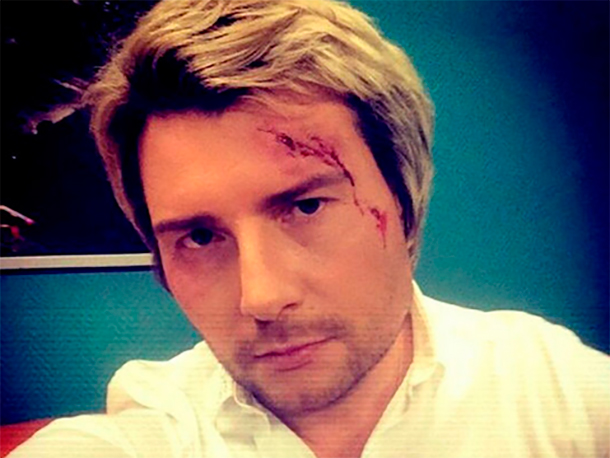 Николай Басков получил серьезную травму головы